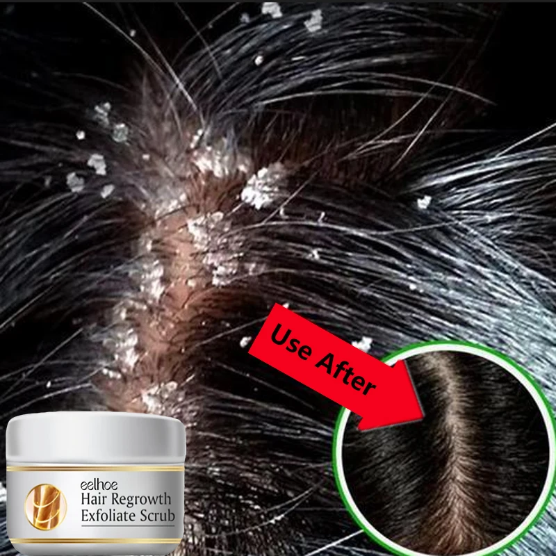 Scalp Scrub Exfoliant - Perawatan Rambut Anti Ketombe Cepat, Scrub